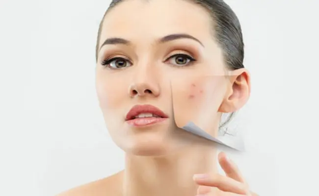Hing Uses for acne